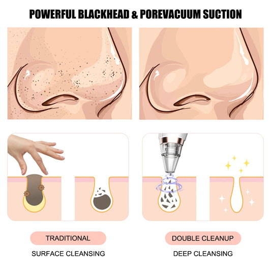 New electric blackhead removal and pore cleaning